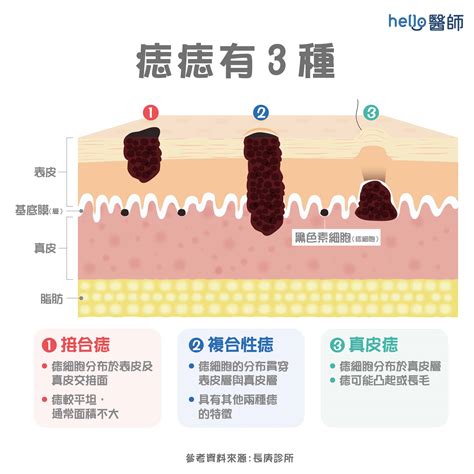 身體的痣|痣形成的原因？痣長毛、痣變多變大是痣病變？5招判。